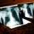Tuberculosis Outbreak Reported In Tokyo?