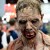 Recent Study Reportedly Reveals Skin Infection Could Possibly Lead to Zombie Outbreak