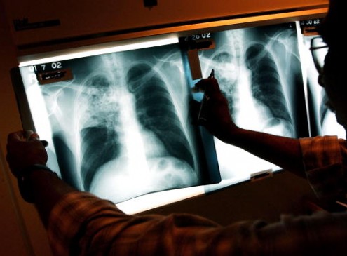 University Of Southampton Researchers Develop 3D System To Fight Tuberculosis