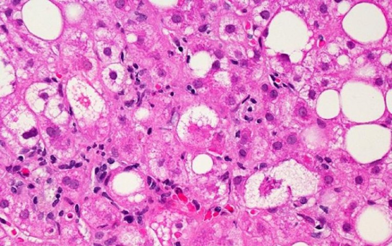 A MICROSCOPIC IMAGE OF LIVER TISSUE AFFECTED BY NON-ALCOHOLIC FATTY LIVER DISEASE (NAFLD). THE LARGE AND SMALL WHITE SPOTS ARE EXCESS FAT DROPLETS FILLING LIVER CELLS (HEPATOCYTES). 