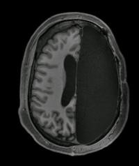 fMRI Scan of Adult with One Hemisphere Removed 