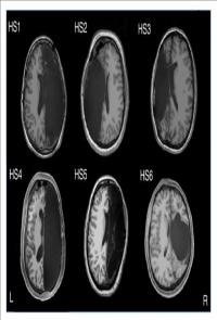 fMRI Scan of Adults with One Hemisphere Removed during Childhood