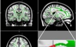 MRI Reveals Brain Damage in Obese Teens
